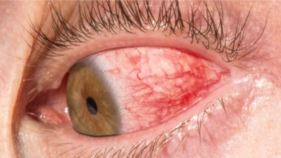 Hyperemia, Types (including Active Hyperemia), Causes, Symptoms